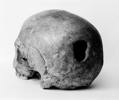 Edinburgh Skull Trepanning Showing Hole In Back Of Skull Wellcome M0009393